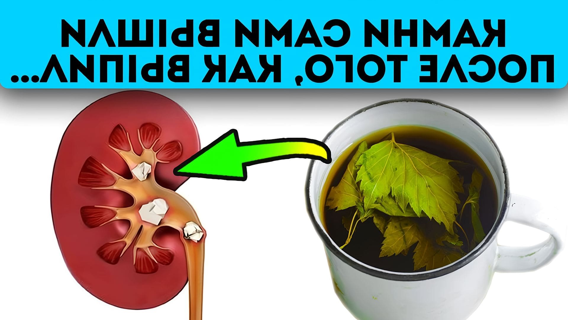 Что растворяет камни в почках. Факторы риска камней в почках. Как быстро вывести камни из почек мужчине. Как быстро вывести камни из почек мужчине. Заболевания мочевыделительной системы мочекаменная болезнь.