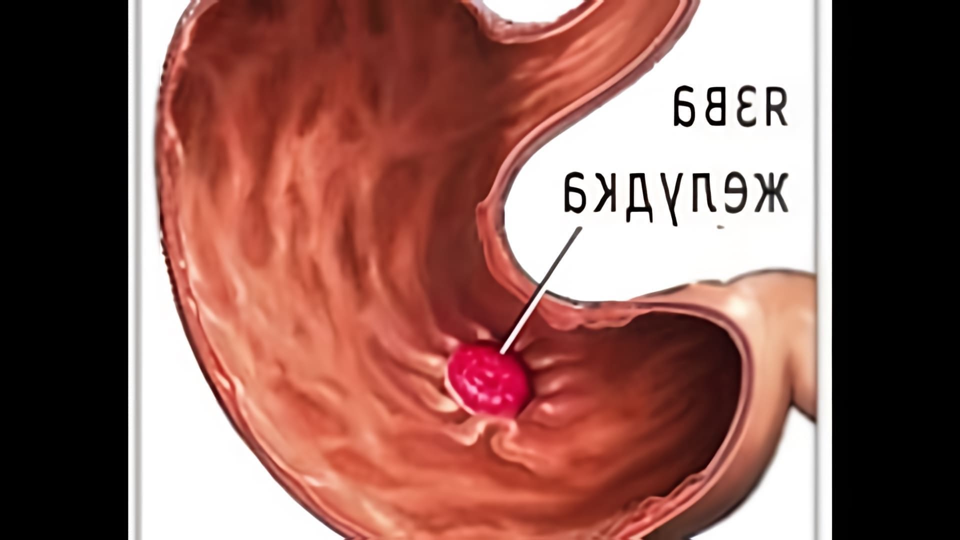 В данном видео рассказывается о народных методах лечения язвы желудка и двенадцатиперстной кишки