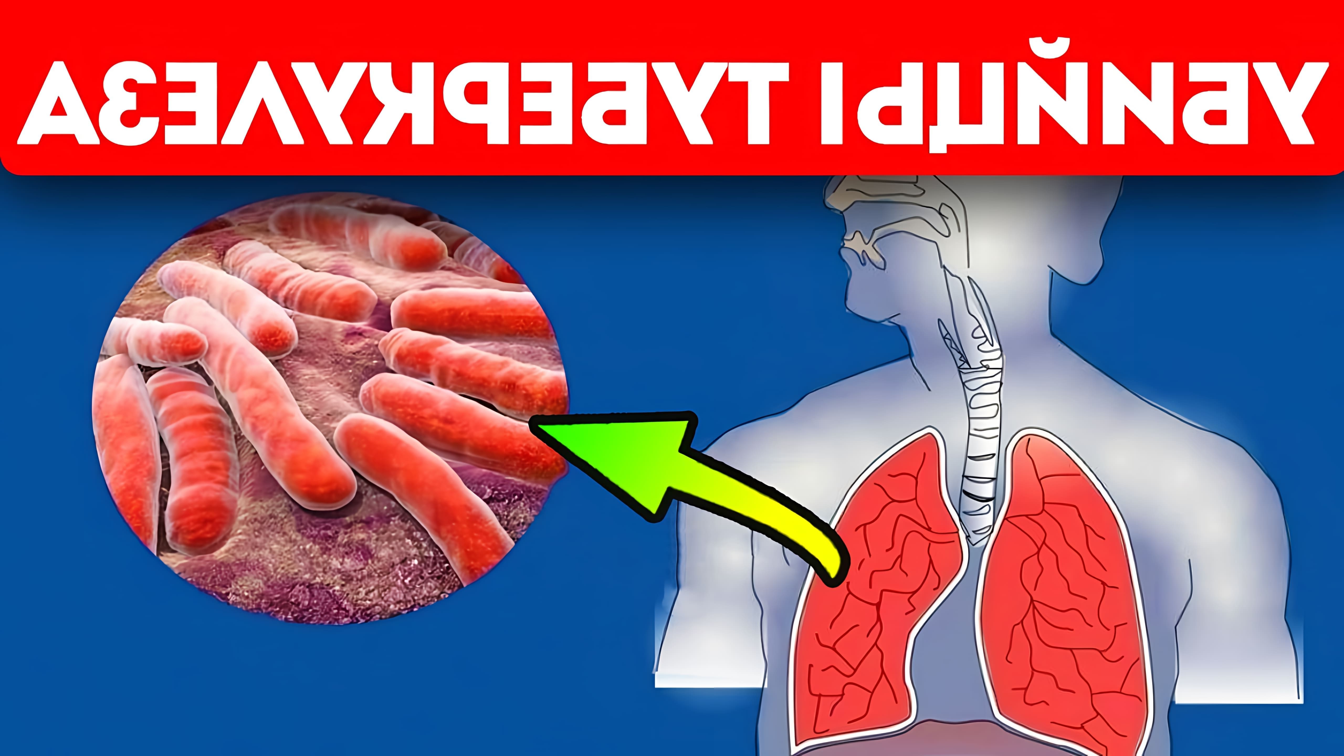 В этом видео рассказывается о туберкулезе, его опасности, способах лечения и профилактики