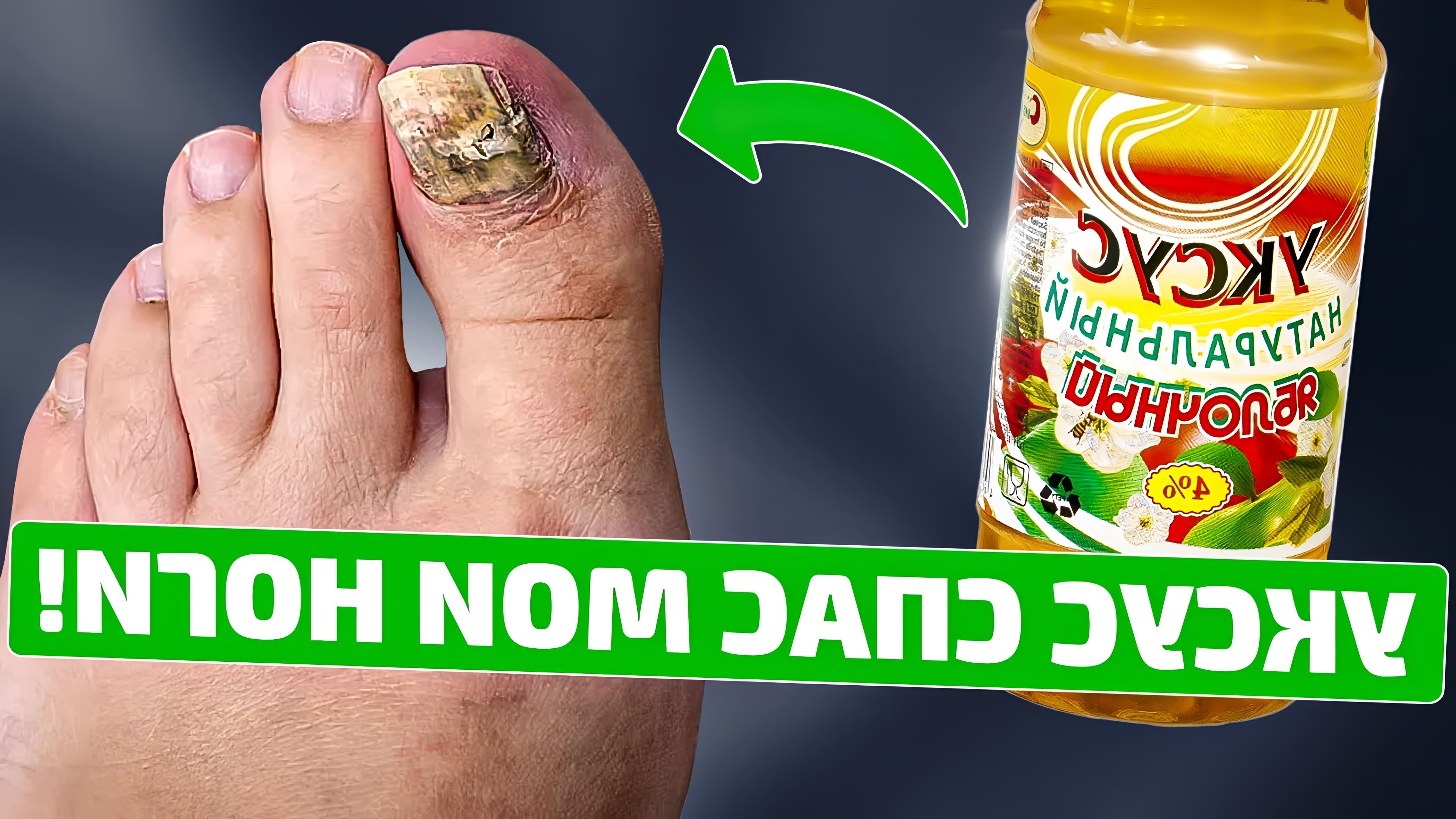 В этом видео рассказывается о пользе яблочного уксуса для кожи ног