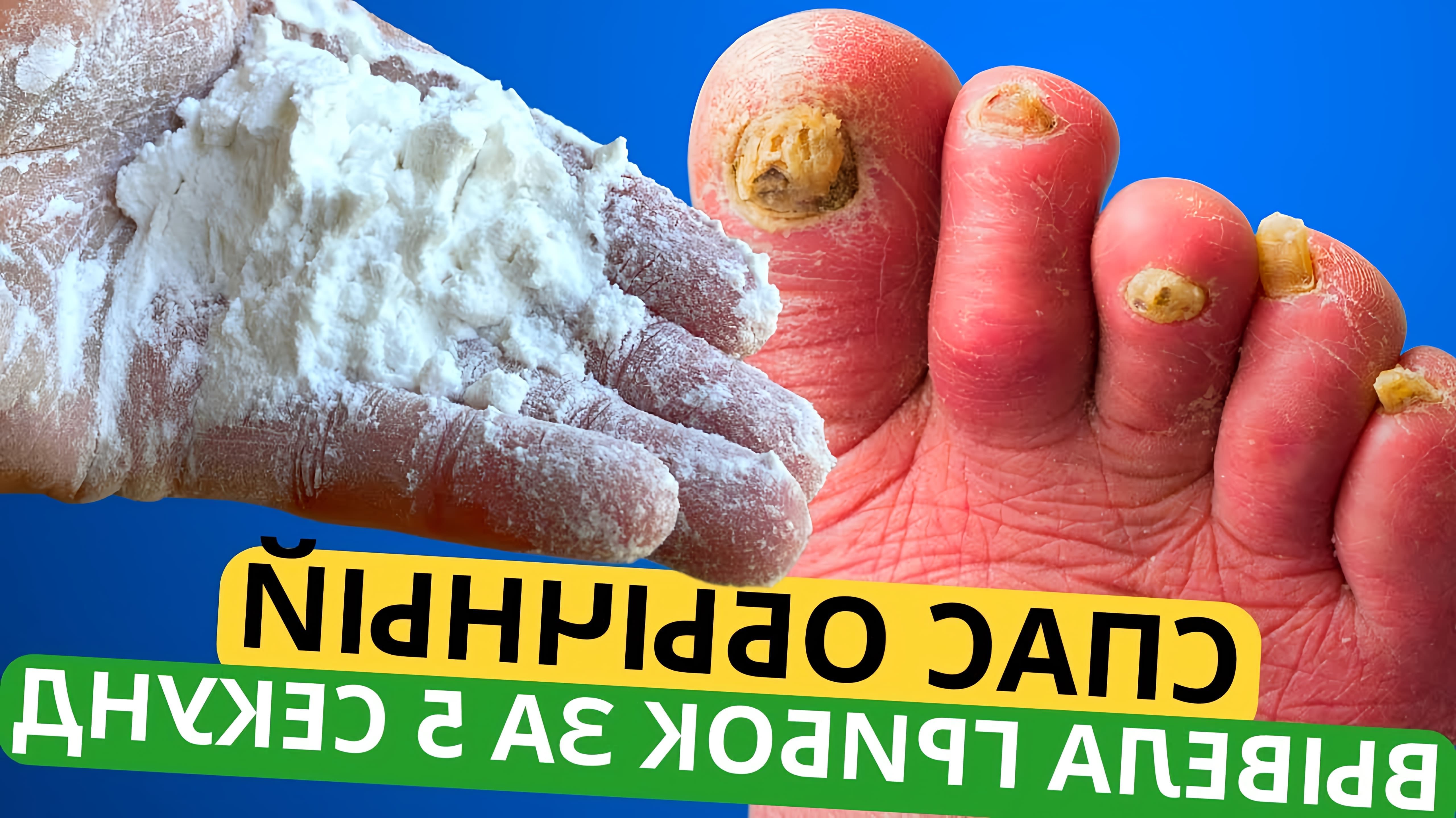 В данном видео рассказывается о простом и эффективном способе лечения грибка ногтей
